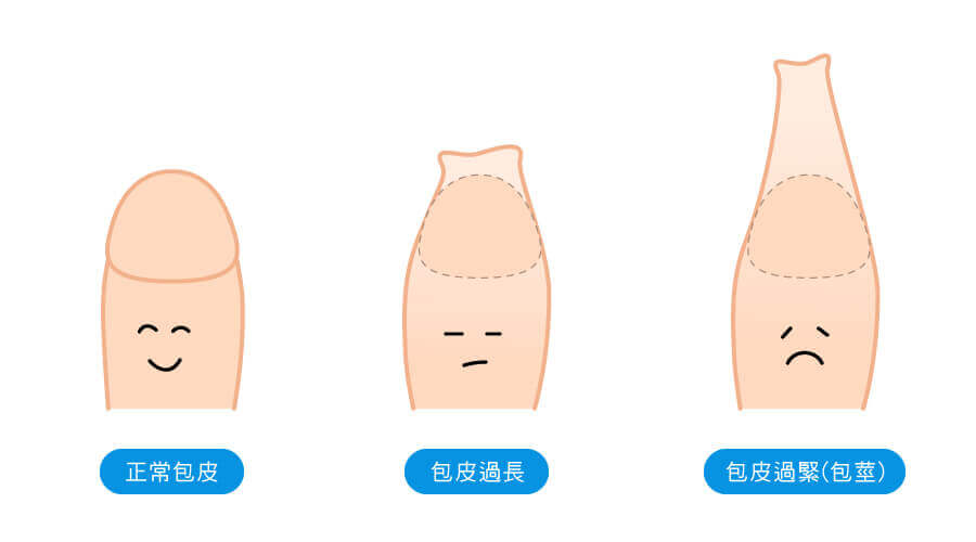 包皮環切手術-雷射包皮環切及一次性包皮槍的第2張圖片